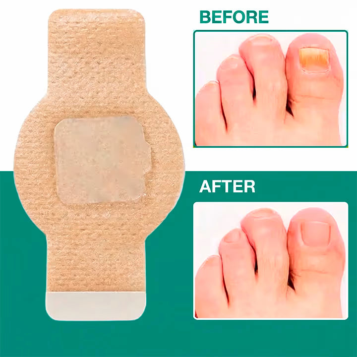 NailLab™ — Fungal Nail Patches